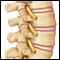Illustration showing bone spurs on spine 
