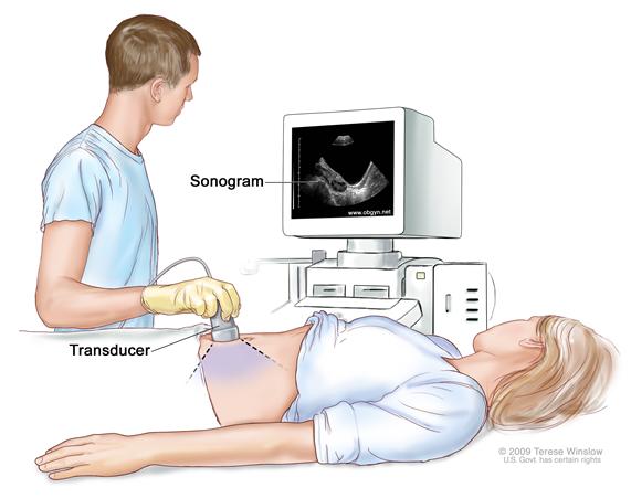 Abdominal ultrasound; drawing shows a woman on an exam table during an abdominal ultrasound procedure. A diagnostic sonographer (a person trained to perform ultrasound procedures) is shown passing a transducer (a device that makes sound waves that bounce off tissues inside the body) over the surface of the patient’s abdomen. A computer screen shows a sonogram (computer picture).