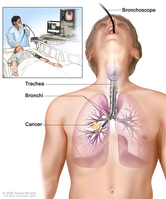 Bronchoscopy; drawing shows a bronchoscope inserted through the mouth, trachea, and bronchus into the lung; lymph nodes along trachea and bronchi; and cancer in one lung. Inset shows patient lying on a table having a bronchoscopy.