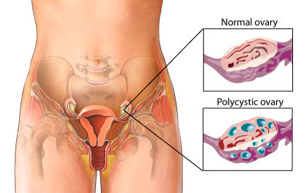 Normal Ovary and Polycystic Ovary