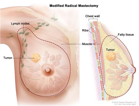 Modified radical mastectomy. The drawing on the left shows the removal of the breast, most or all of the lymph nodes under the arm, the lining over the chest muscles and sometimes part of the chest wall muscles. The drawing on the right shows a cross-section of the breast including the chest wall (ribs and muscle), fatty tissue, and the tumor.