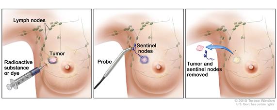 Sentinel lymph node biopsy of the breast.  The first of three panels shows a  radioactive substance and/or blue dye injected near the tumor; the middle panel shows that the injected material is followed visually and/or with a probe that detects radioactivity to find the sentinel nodes (the first lymph nodes to take up the material); the third panel shows the removal of the tumor and the sentinel nodes to check for cancer cells.
