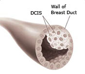 Illustration of a breast duct showing the wall of the breast duct and a ductal carcinoma in situ (DCIS)