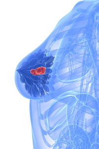 diagram of a breast showing a tumor