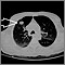 Lung mass, right upper lobe - CT scan