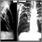 Tuberculosis avanzada, radiografía de tórax