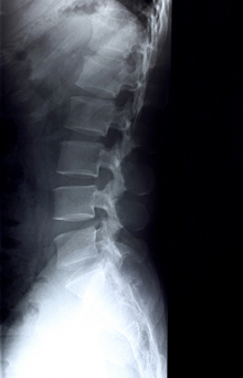 X-ray of lumbar spine