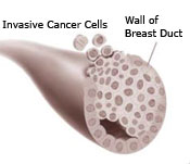 Illustration of a breast duct showing the wall of the breast duct and invasive cancer cells)