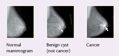 From left to right: Normal mammogram, Benign cyst (not cancer), Cancer