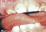 Photo of dental caries 