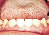 Photo of severe periodontal disease