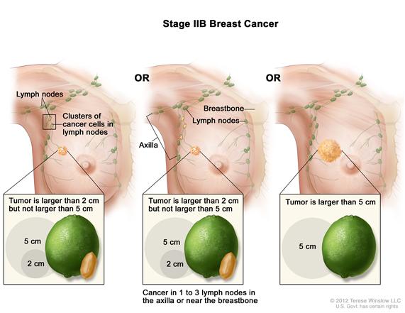 Stage IIB breast cancer. The drawing on the left shows the tumor is larger than 2 cm but not larger than 5 cm and small clusters of cancer cells are in the lymph nodes. The drawing in the middle shows the tumor is larger than 2 centimeters but not larger than 5 centimeters and cancer is in 3 axillary lymph nodes. The drawing on the right shows the tumor is larger than 5 cm but has not spread to the lymph nodes.