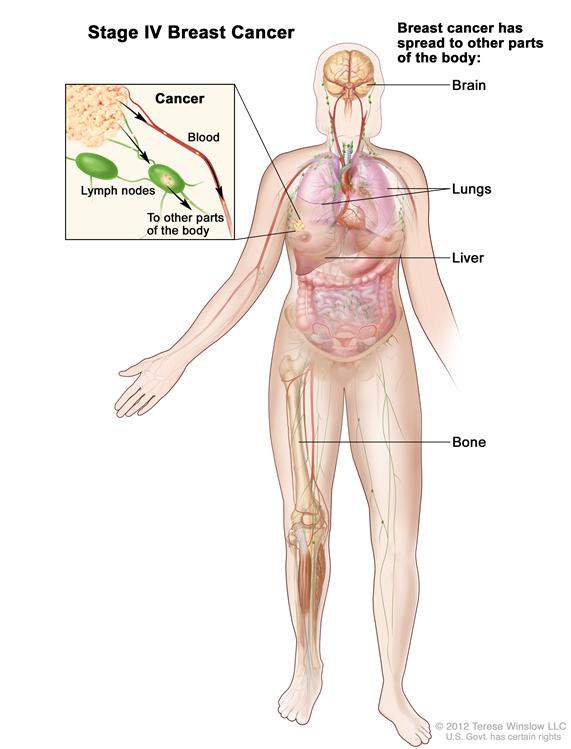 Stage IV breast cancer. Drawing shows cancer has spread from lymph nodes through the blood to other parts of the body, such as the brain, lungs, liver, and bone.