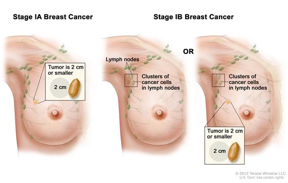 Stage I breast cancer. Drawing shows stage IA on the left; the tumor is 2 cm or smaller and has not spread outside the breast. Drawings in the middle and on the right show stage IB. In the middle, no tumor is found in the breast, but small clusters of cancer cells are found in the lymph nodes. In the drawing on the right, the tumor is 2 cm or smaller and small clusters of cancer cells are found in the lymph nodes.