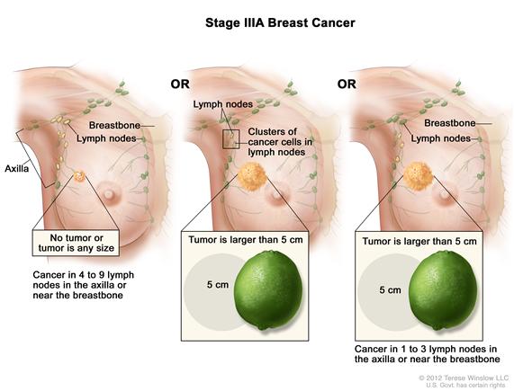 Stage IIIA breast cancer. The drawing on the left shows no tumor in the breast; cancer is found in 8 axillary lymph nodes. In the drawing in the middle, the tumor is larger than 5 centimeters and small clusters of cancer cells are in the lymph nodes. The drawing on the right shows the tumor is larger than 5 cm and cancer is in 3 axillary lymph nodes.