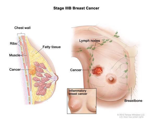 Stage IIIB breast cancer. The drawing on the left is a cross section of the breast showing  that cancer has spread to the chest wall. The ribs, muscle, and fatty tissue are also shown. The drawing on the right shows the tumor has spread to the skin of the breast. An inset shows inflammatory breast cancer.