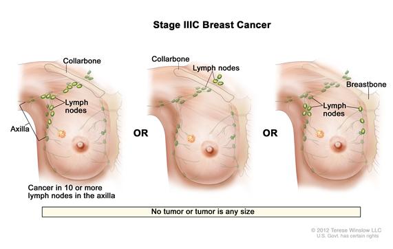 Stage IIIC breast cancer. Drawing on the left shows cancer in lymph nodes in the axilla. Drawing in the middle shows cancer is in lymph nodes above the collarbone. Drawing on the right shows cancer in the axillary lymph nodes and in lymph nodes near the breastbone.