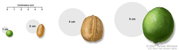 Tumor size compared to everyday objects; shows various measurements of a tumor compared to a pea, peanut, walnut, and lime