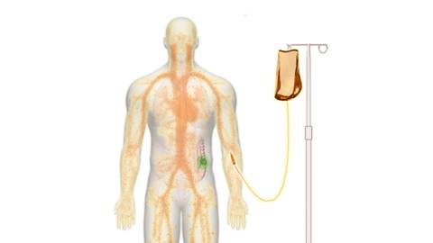 This is an image of a human body connected to an intravenous (IV) fluid bag containing a chemotherapeutic agent. The chemotherapeutic agent from the IV fluid bag has entered the body and is running through the body's circulatory system.