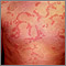 Hives (urticaria) on the chest