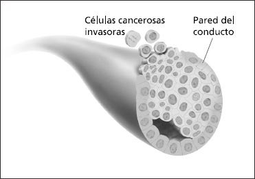 Esta ilustración muestra células cancerosas que se han diseminado fuera del conducto y han invadido tejido cercano dentro del seno.