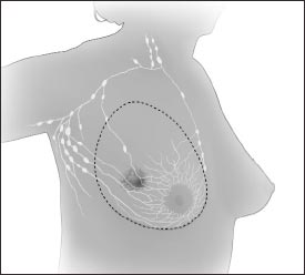 En la mastectomía total (simple), el cirujano extirpa todo el seno. Es posible que también extirpe algunos de los ganglios linfáticos bajo el brazo.
