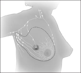 En la mastectomía radical modificada, el cirujano extirpa todo el seno y casi todos o todos los ganglios linfáticos bajo el brazo. Con frecuencia, se extirpa el revestimiento que está sobre los músculos del pecho. Es posible que también se quite un pequeño músculo del pecho para poder extirpar más fácilmente los ganglios linfáticos.