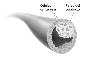 Esta ilustración muestra el carcinoma ductal in situ.