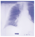 image of laboratory tests of fluid or tissue from the lungs