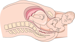 Diagram of a baby in the birth canal crowning