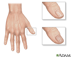 Illustration of a normal thumb nail and a dry, brittle thumb nail