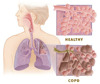 Illustration of respiratory system - cross section of healthy and COPD alveoli