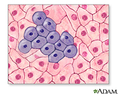 Illustration of cancer cells