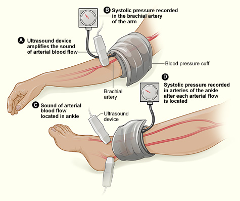 The illustration shows the ankle-brachial index test. The test compares blood pressure in the ankle to blood pressure in the arm. As the blood pressure cuff deflates, the blood pressure in the arteries is recorded.