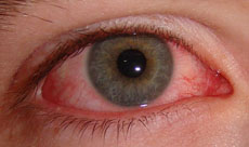 An eye with conjunctivitis