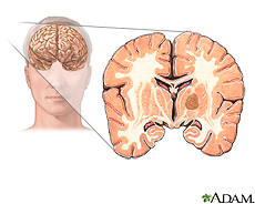 Illustration of a brain tumor