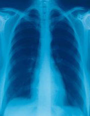 Photograph of a chest x-ray