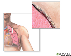 Illustration of the lung featuring the pleural space