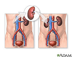 Illustration of kidney transplantation