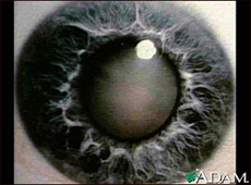 Photograph of a cataract