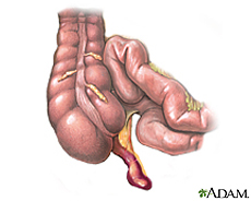 Illustration of an infected appendix
