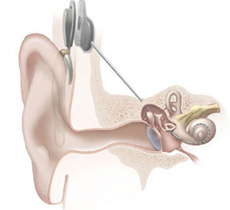 Illustration of ear with cochlear implant.