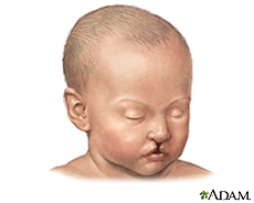 Illustration of a baby with a cleft lip