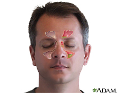 Illustration of the sinuses and sinusitis