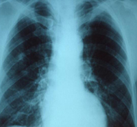 Photo: Chest x-ray of patient with pneumonia