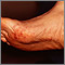 Cholesterol emboli Livedo Reticularis - feet