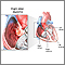 Right atrial myxoma