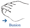 Drawing of a foot with an arrow pointing to a bunion.