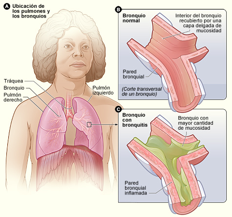 La figura A muestra la ubicaci&oacute;n de los pulmones y de los bronquios en el cuerpo. La figura B es una vista ampliada y detallada de un bronquio normal. La figura C es una vista ampliada y detallada de un bronquio con bronquitis. El tubo (bronquio) est&aacute; inflamado y contiene m&aacute;s mucosidad que de costumbre.