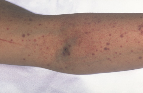 The photograph shows purpura (bruises) and petechiae (dots) in the skin. Bleeding under the skin causes the purple, brown, and red colors of the purpura and petechiae. 
